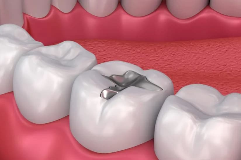 Dental treatment