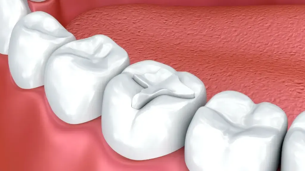 Dental procedure